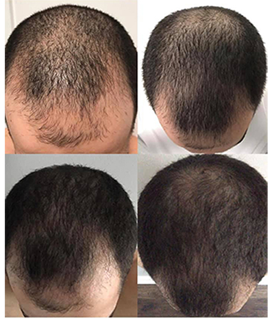 scalp pop